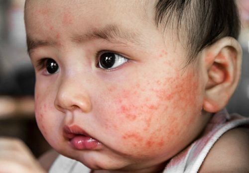 Eczema: Recognizing signs and how to take care of your baby