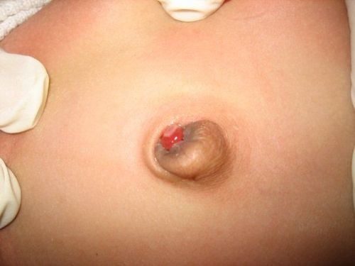 Treatment of umbilical granulomatosis in infants