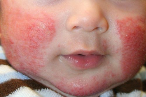 Chú ý dưỡng ẩm khi chăm sóc da ở trẻ bị viêm da cơ địa