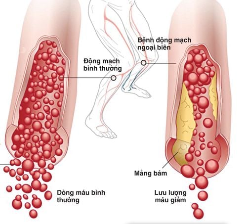 Cảnh giác với tắc động mạch ngoại biên chi dưới