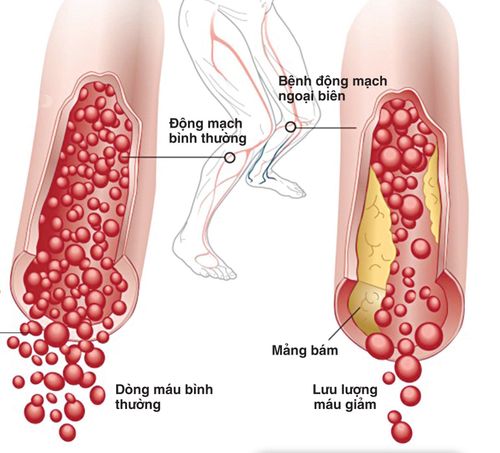 Beware of lower extremity peripheral artery occlusion