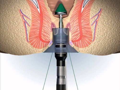 Surgical hemorrhoid reduction using the Longo method
