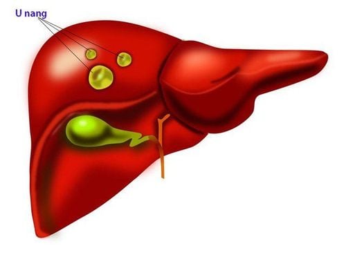 Is 11mm left liver cyst dangerous?