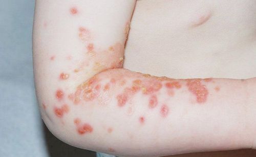 Recognizing the signs of skin impetigo in children