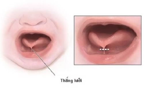 19 tuổi có cắt dính thắng lưỡi được không?