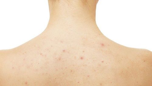 Long-lasting folliculitis, easy to recur