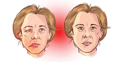 Myasthenia gravis (myasthenia gravis)