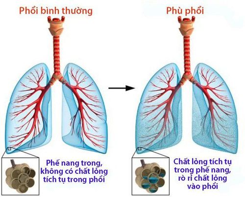 
Image of pulmonary edema
