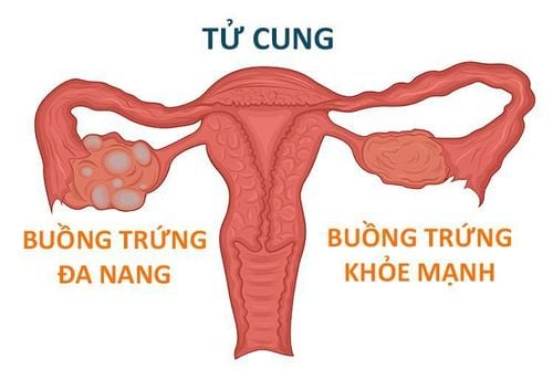 
Buồng trứng đa nang là tình trạng phụ nữ có quá nhiều hormone sinh dục nam trong cơ thể trong khi lượng hormone sinh dục nữ lại có ít
