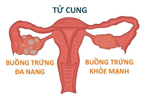 Thai phụ phát hiện u nang buồng trứng cần điều trị như thế nào?