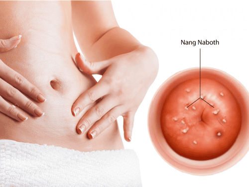 Cervical nabothian cyst: When to treat?