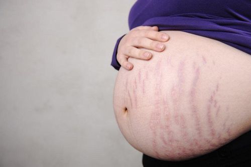 Stretch marks during pregnancy: Why do some people get it, some don't?