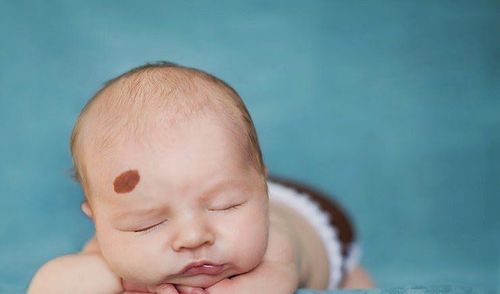 Learn about common birthmarks in babies