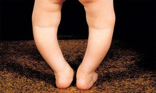 What to do when the baby's legs are bowed?