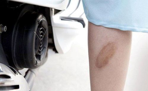 How to treat motorcycle potty burns without leaving scars