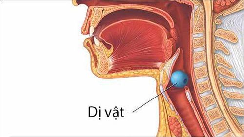 
Ngạt thở là tình trạngi không thể thở hoặc nói vì họng hoặc khí quản bị tắc nghẽn hoàn toàn
