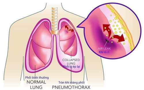 
Tràn khí màng phổi là biến chứng của ngạt đường thở do dị vật
