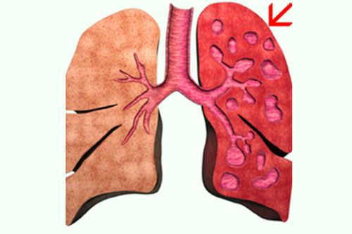 Indications for bronchodilator surgery