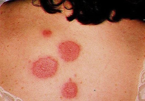 Sweet's syndrome (neutropenic skin disease)