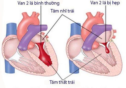 Low posterior mitral stenosis