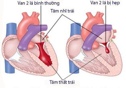 Clinical and subclinical symptoms of mitral stenosis