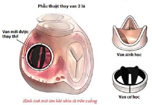 
Van nhân tạo có thể bao gồm toàn bộ chất liệu nhân tạo (van cơ học) hoặc có thể được làm từ các van tim của động vật, thường là từ heo (van sinh học)
