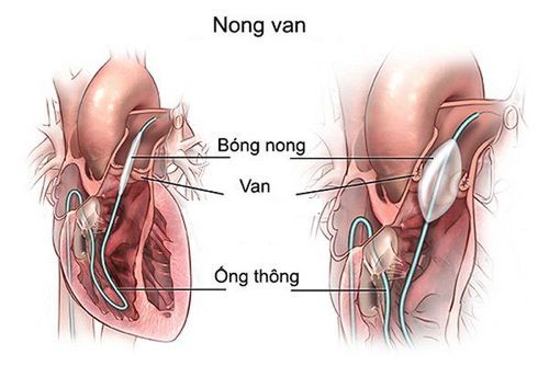 
Kỹ thuật dùng bóng nong inoue điều trị hẹp van tim 2 lá
