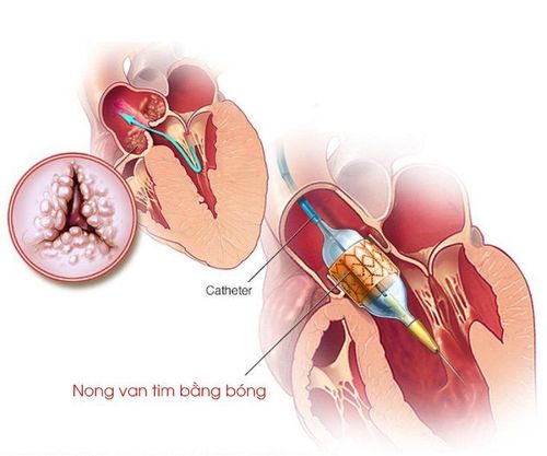 
Nong van tim bằng bóng được chỉ định trên bệnh nhân hẹp van tim đơn thuần
