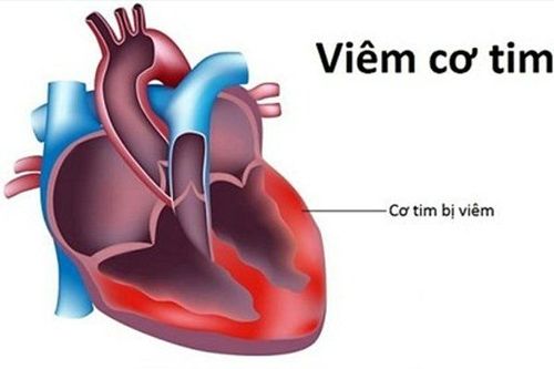 Chẩn đoán và điều trị viêm cơ tim