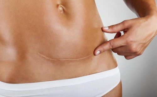 How long does it take for the perineal suture to dissolve?