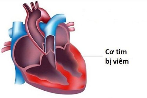 
Viêm cơ tim là một biến chứng của bệnh bạch hầu
