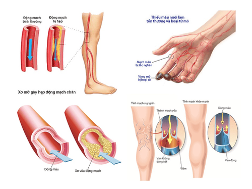 
Bệnh Buerger là một trong những nguyên nhân gây nên tình trạng viêm các mạch máu ở chân và tay, đặc biệt vùng bàn tay bàn chân
