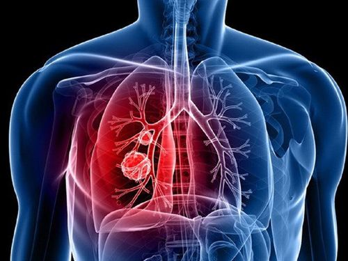 How long does radiation therapy for lung cancer last?