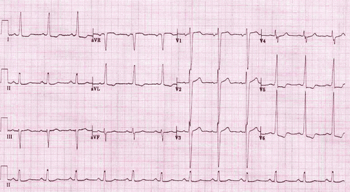 Cardiac arrhythmia results