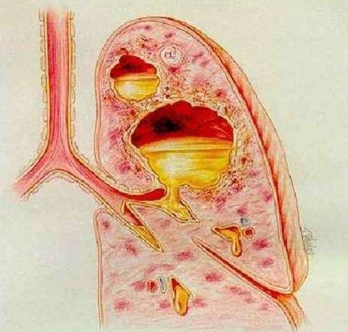 
Áp xe phổi, gan có thể do vi khuẩn burkholderia cepacia gây ra
