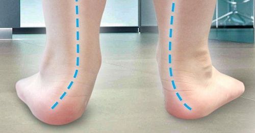 Do flat feet in children need treatment?