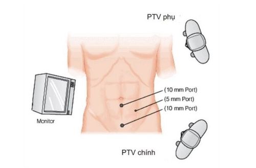 
Viêm ruột thừa có thể gặp ở mọi lứa tuổi khác nhau và gây ra nhiều biến chứng nguy hiểm
