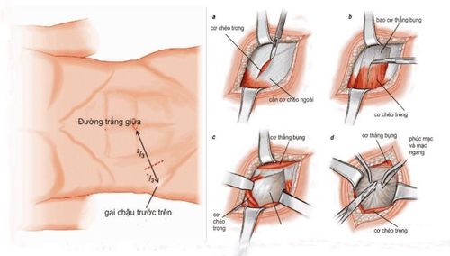 
Mổ ruột thừa bằng phương pháp mổ hở
