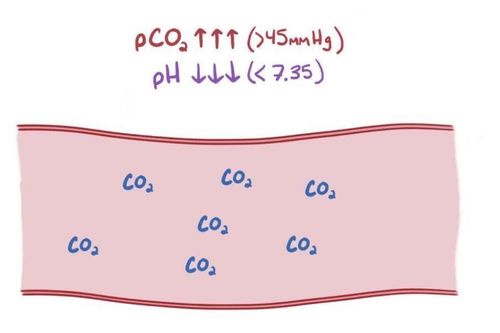 What is respiratory acidosis?