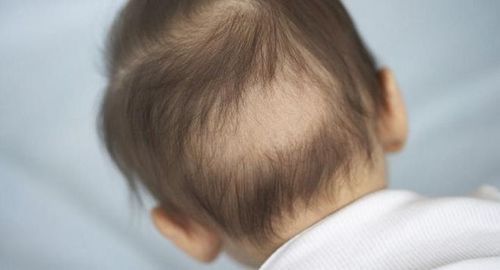 Thiếu kẽm ở trẻ gây hiện tượng rụng tóc