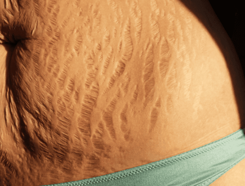 Treatment of stretch marks after childbirth