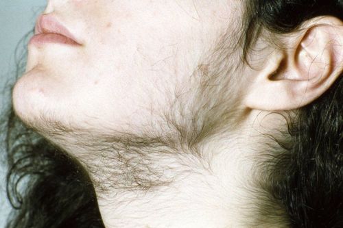 Hirsutism in women is associated with what health problems?