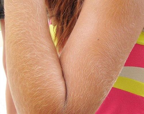 Overcoming hirsutism in women