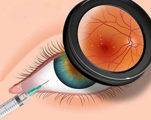 Treatment of macular degeneration