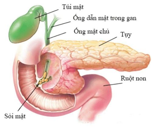 Methods of diagnosis and treatment of common bile duct stones