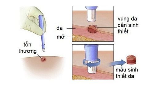 Skin mole biopsies: What should be noted?