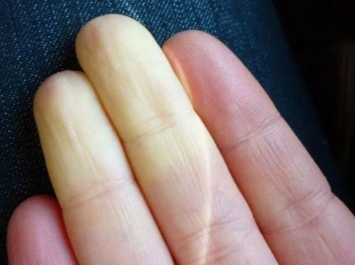 Treatment of Raynaud's syndrome