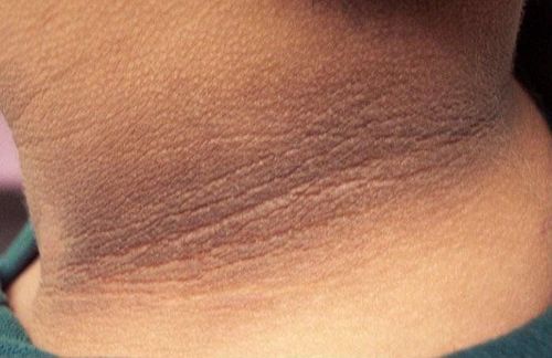 
Hình ảnh bệnh gai đen (acanthosis nigricans)
