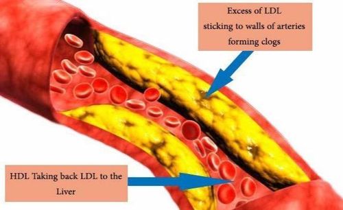 
LDL gây vữa xơ động mạch
