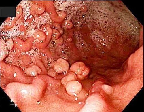 
Đa polyp tuyến gia đình.
